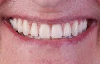 Implantes dentários